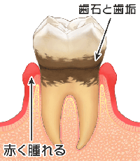 歯周病の進行度（中程度）