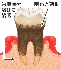 歯周病の進行度（重度）