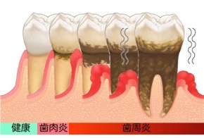 歯周病の進行と歯肉と歯槽骨の変化