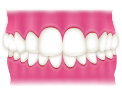 過蓋咬合歯列図