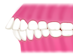 上顎前突歯列図