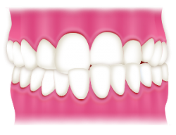交差咬合歯列図