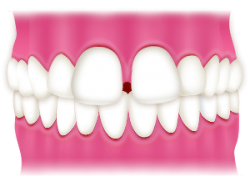 すきっ歯（空隙歯列）